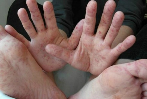 Autoridades sanitarias de México alertas por enfermos de virus Coxsackie
