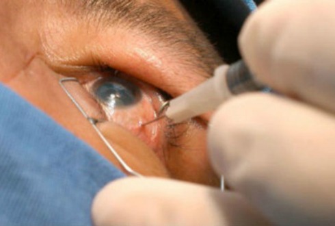 Diseñan app para facilitar cirugía de cataratas 