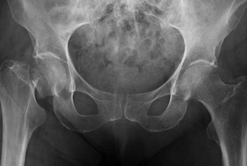 Fracturas de cadera ligadas a osteoporosis pueden causar enfermedades mortales