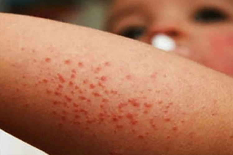 Suma Jalisco 231 casos de sarampión