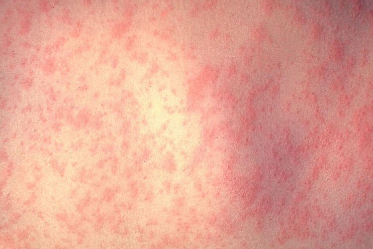 Secretaría de Salud Jalisco reporta 346 casos de sarampión 