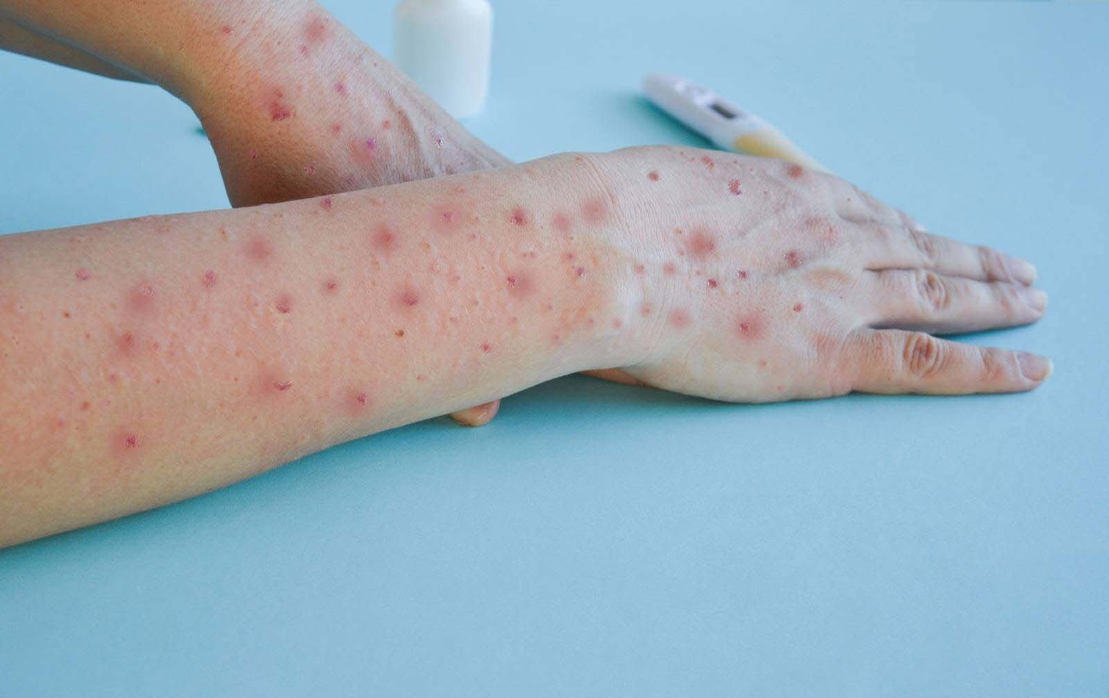 Llama IMSS al aislamiento ante casos de sarampión