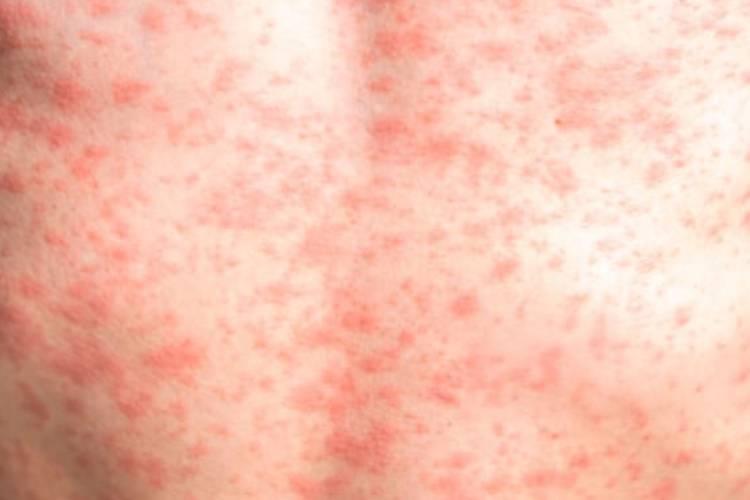 Sarampión cobra 28 vidas en México, confirman nueva defunción en la CDMX