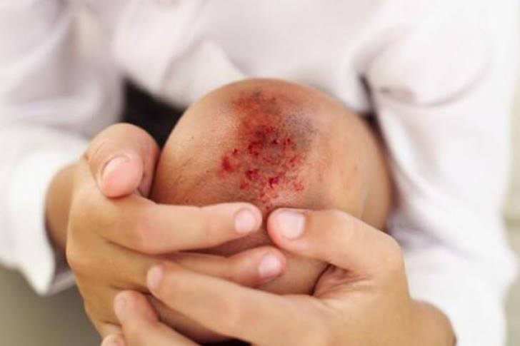 Llama IMSS Jalisco a reforzar autocuidado por hemofilia