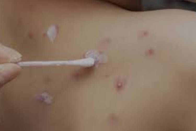 Reportan cuatro casos de varicela en CUValles